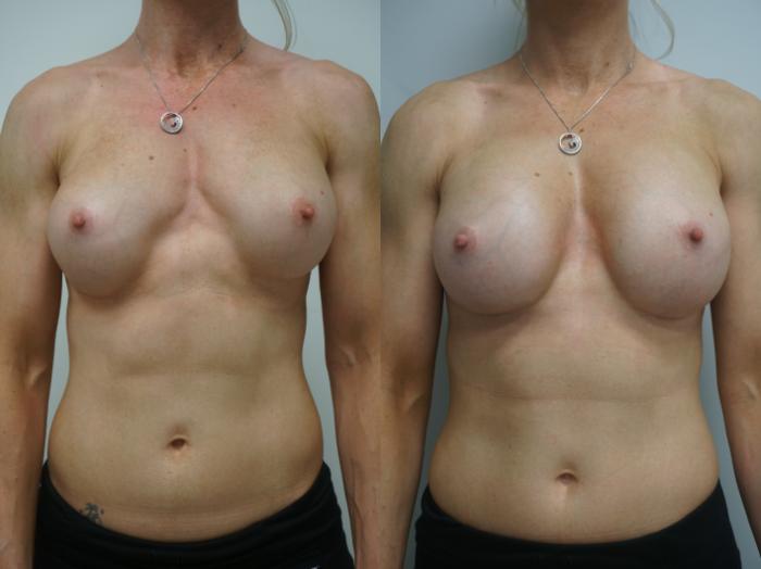 Before & After Breast Implant Exchange Case 196 View #1 View in Gilbert, AZ