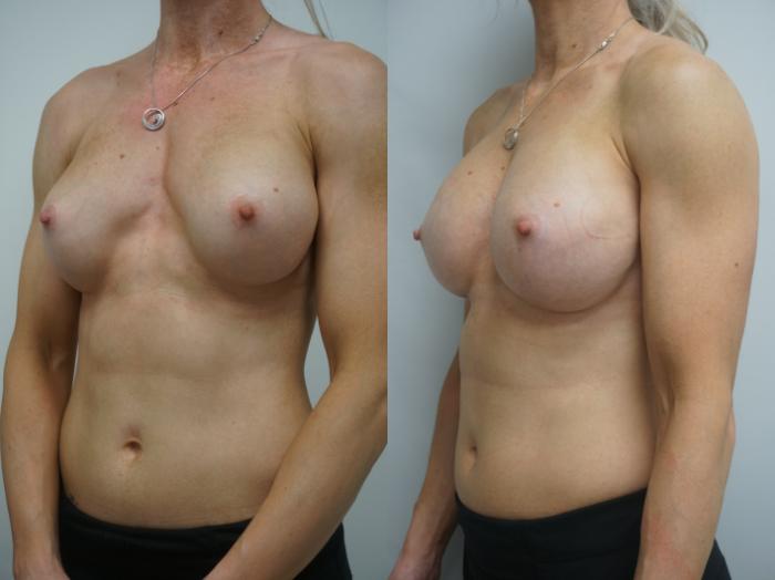 Before & After Breast Implant Exchange Case 196 View #2 View in Gilbert, AZ