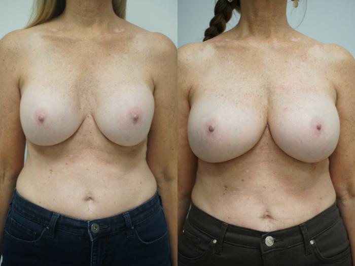Before & After Breast Implant Exchange Case 216 View #1 View in Gilbert, AZ