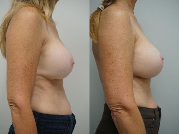 Before & After Breast Implant Exchange Case 216 View #2 View in Gilbert, AZ