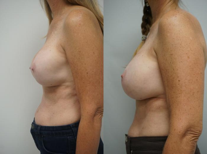Before & After Breast Implant Exchange Case 216 View #3 View in Gilbert, AZ