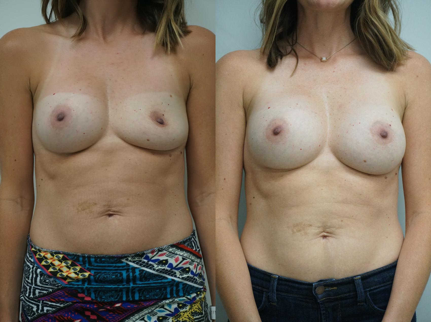 Before & After Breast Implant Exchange Case 224 View #1 View in Gilbert, AZ