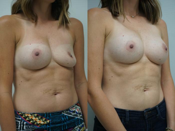 Before & After Breast Implant Exchange Case 224 View #2 View in Gilbert, AZ