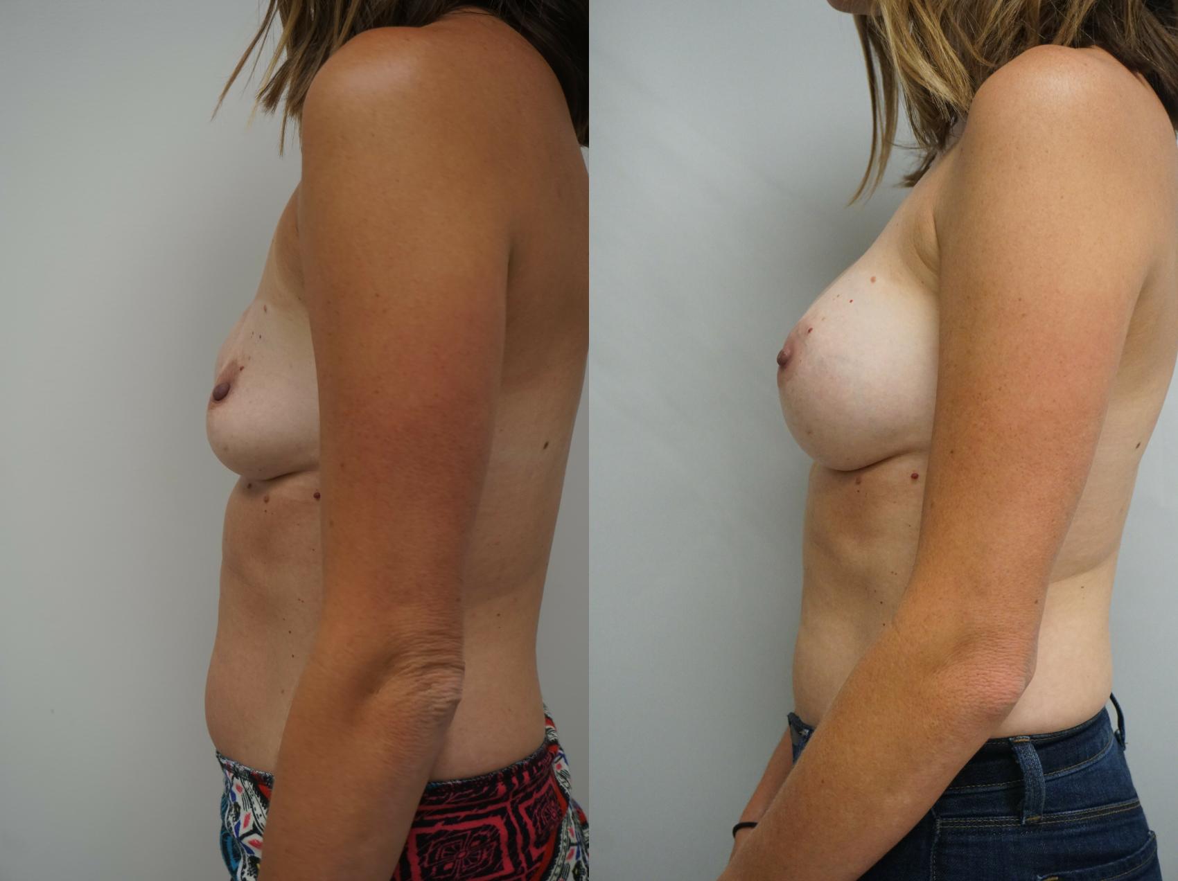 Before & After Breast Implant Exchange Case 224 View #3 View in Gilbert, AZ