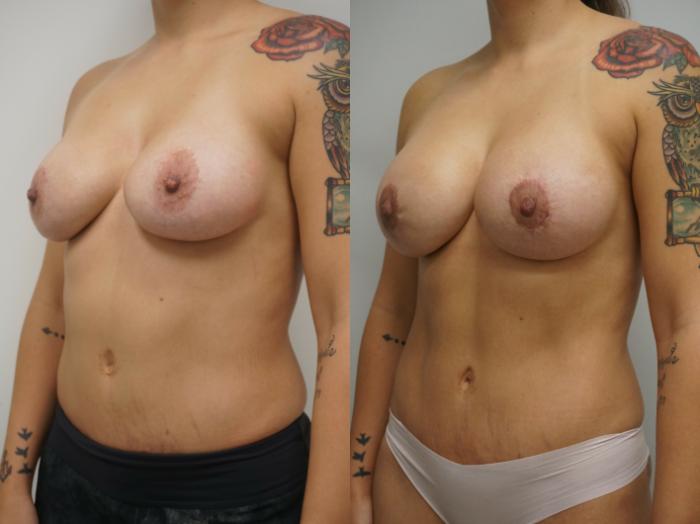 Before & After Breast Implant Exchange Case 227 View #1 View in Gilbert, AZ