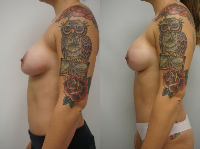 Before & After Breast Implant Exchange Case 227 View #2 View in Gilbert, AZ