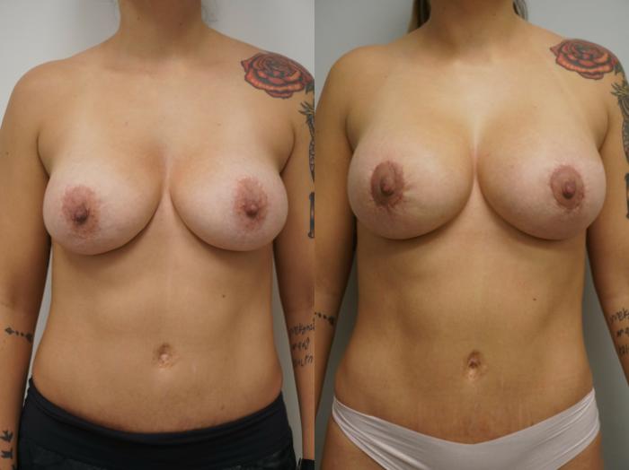 Before & After Breast Implant Exchange Case 227 View #3 View in Gilbert, AZ
