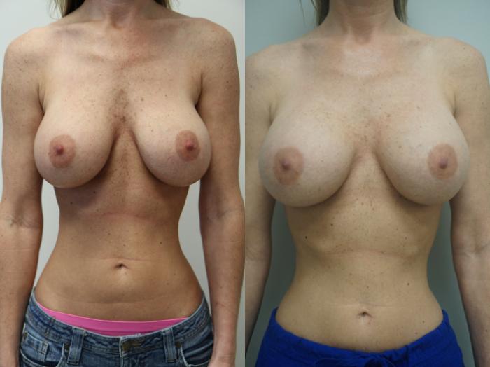 Before & After Breast Implant Exchange Case 231 View #1 View in Gilbert, AZ