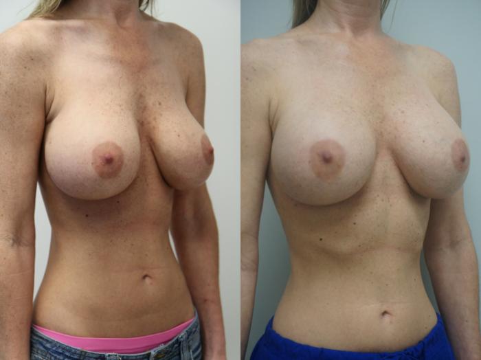 Before & After Breast Implant Exchange Case 231 View #2 View in Gilbert, AZ