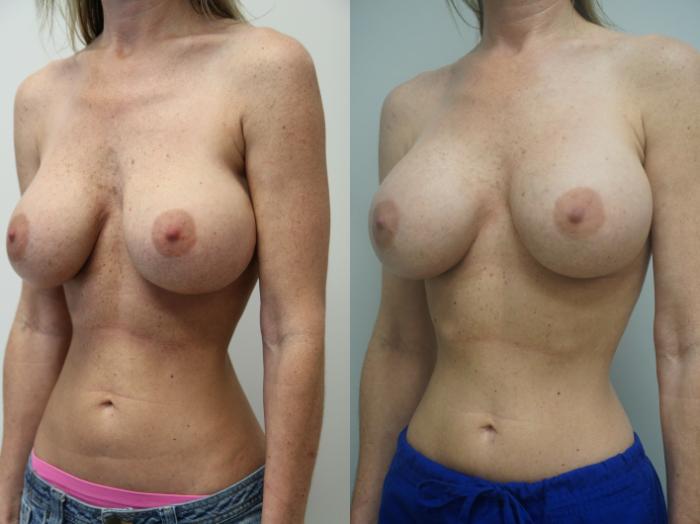 Before & After Breast Implant Exchange Case 231 View #3 View in Gilbert, AZ