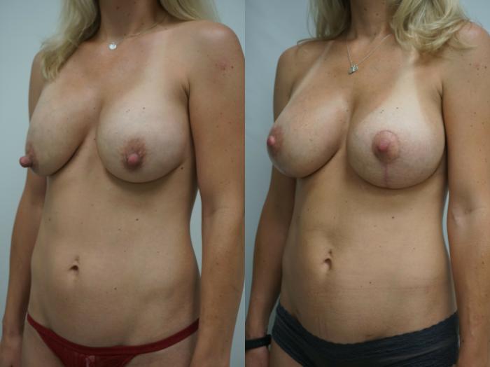 Before & After Breast Implant Exchange Case 237 View #2 View in Gilbert, AZ