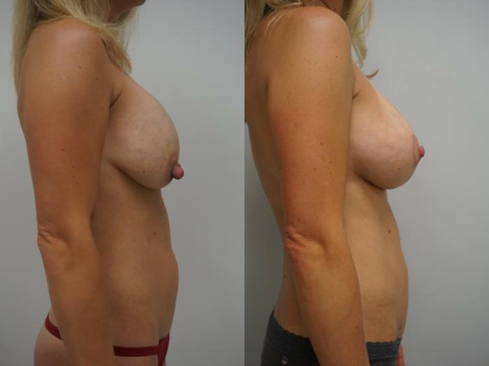 Before & After Breast Implant Exchange Case 237 View #3 View in Gilbert, AZ
