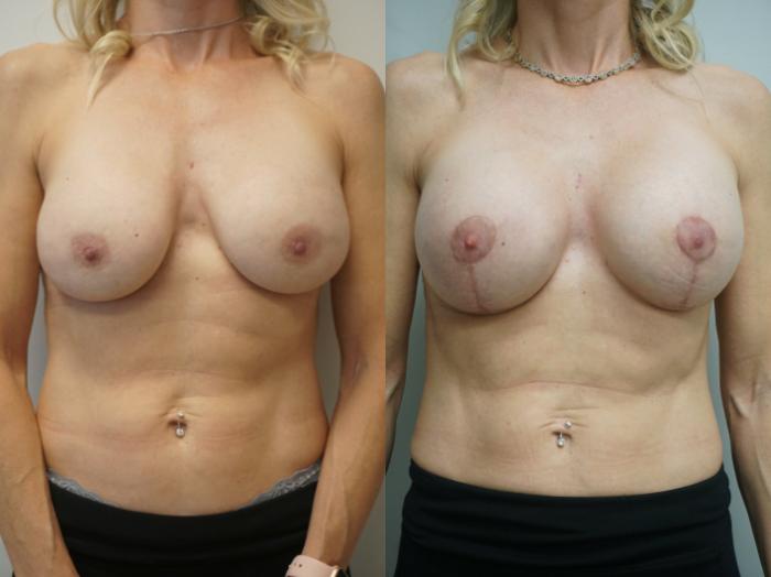 Before & After Breast Implant Exchange Case 239 View #1 View in Gilbert, AZ
