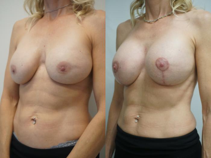 Before & After Breast Implant Exchange Case 239 View #2 View in Gilbert, AZ