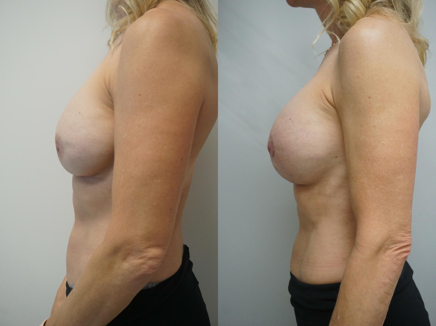 Before & After Breast Implant Exchange Case 239 View #3 View in Gilbert, AZ