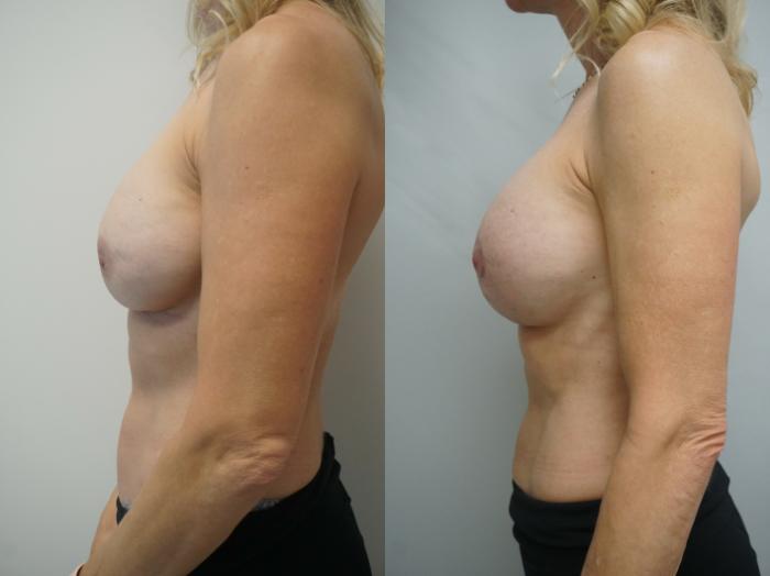 Before & After Breast Implant Exchange Case 239 View #3 View in Gilbert, AZ