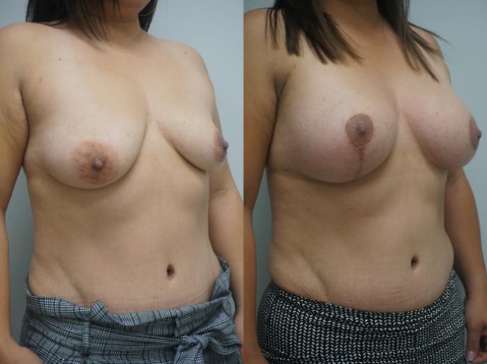 Before & After Breast Implant Exchange Case 258 View #2 View in Gilbert, AZ