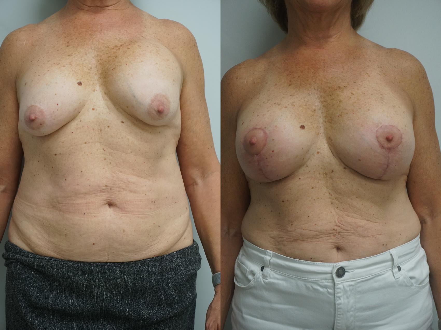 Before & After Breast Implant Exchange Case 325 Front View in Gilbert, AZ