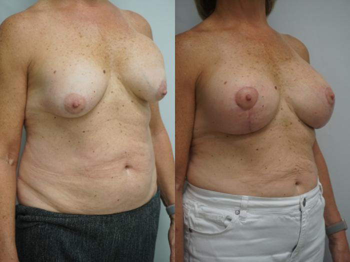 Before & After Breast Implant Exchange Case 325 Right Oblique View in Gilbert, AZ