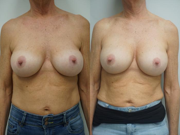 Before & After Breast Implant Exchange Case 326 Front View in Gilbert, AZ