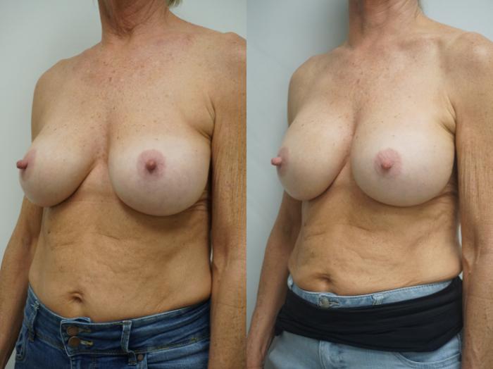 Before & After Breast Implant Exchange Case 326 Left Oblique View in Gilbert, AZ