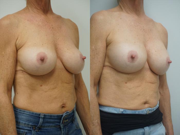 Before & After Breast Implant Exchange Case 326 Right Oblique View in Gilbert, AZ