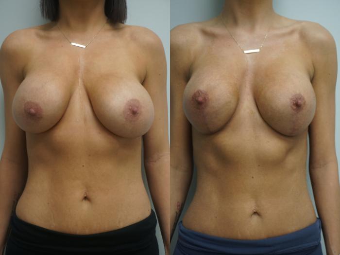 Before & After Breast Implant Exchange Case 327 Front View in Gilbert, AZ