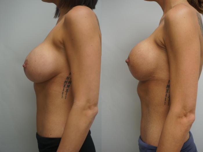 Before & After Breast Implant Exchange Case 327 Left Side View in Gilbert, AZ