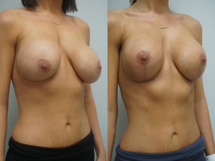 Before & After Breast Implant Exchange Case 327 Right Oblique View in Gilbert, AZ