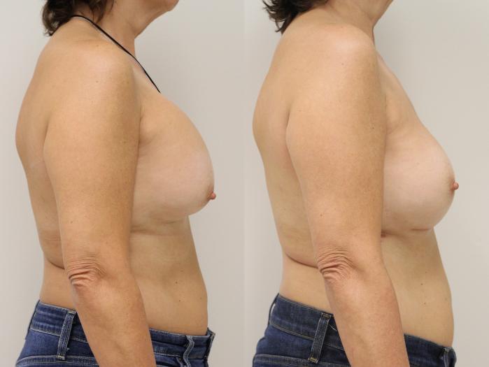 Before & After Breast Implant Exchange Case 35 View #1 View in Gilbert, AZ