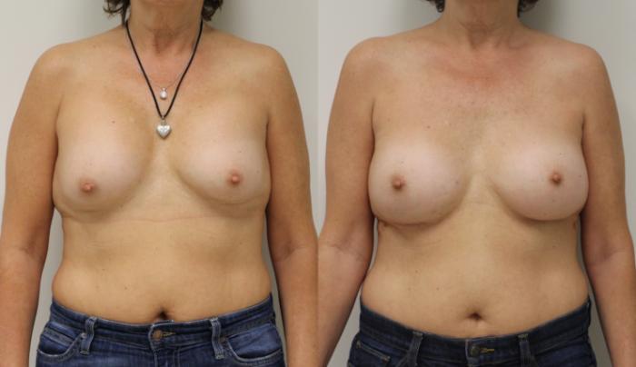 Before & After Breast Implant Exchange Case 35 View #2 View in Gilbert, AZ