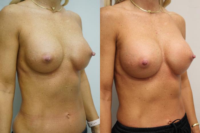 Before & After Breast Implant Exchange Case 426 Right Oblique View in Gilbert, AZ