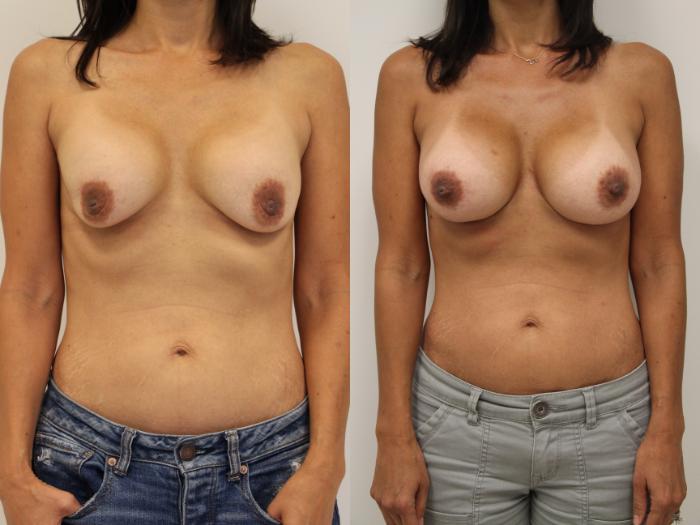 Before & After Breast Implant Exchange Case 48 View #2 View in Gilbert, AZ