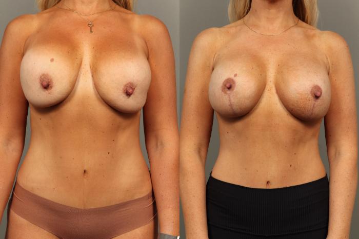 Before & After Breast Implant Exchange with Breast Lift  Case 446 Front View in Gilbert, AZ