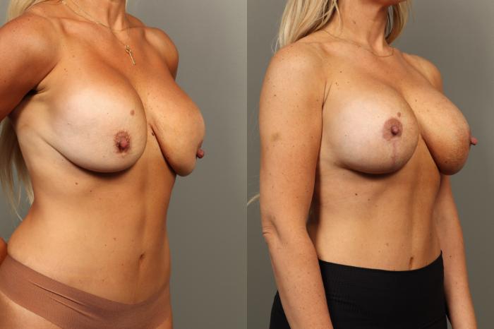 Before & After Breast Implant Exchange with Breast Lift  Case 446 Right Oblique View in Gilbert, AZ