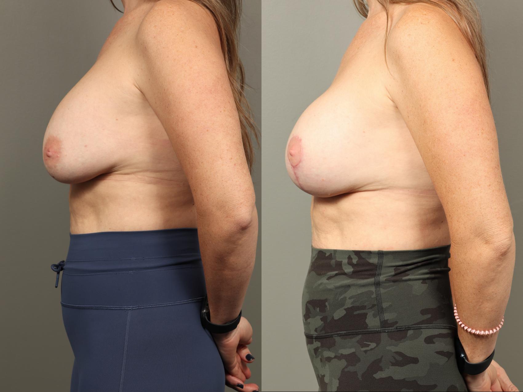 Before & After Breast Implant Exchange with Breast Lift  Case 482 Left Side View in Gilbert, AZ