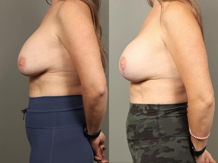 Before & After Breast Implant Exchange with Breast Lift  Case 482 Left Side View in Gilbert, AZ