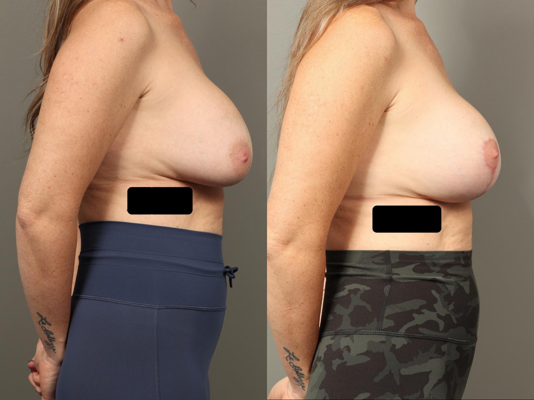 Before & After Breast Implant Exchange with Breast Lift  Case 482 Right Side View in Gilbert, AZ