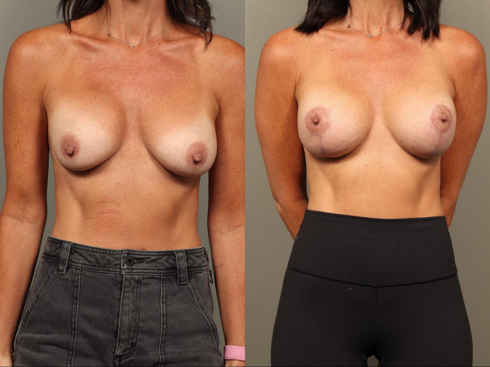 Before & After Breast Implant Exchange with Breast Lift  Case 501 Front View in Gilbert, AZ