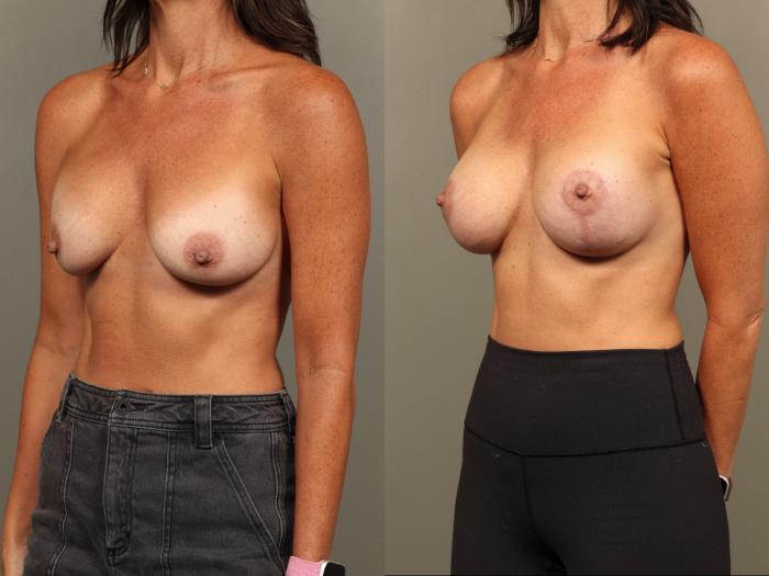 Before & After Breast Implant Exchange with Breast Lift  Case 501 Left Oblique View in Gilbert, AZ