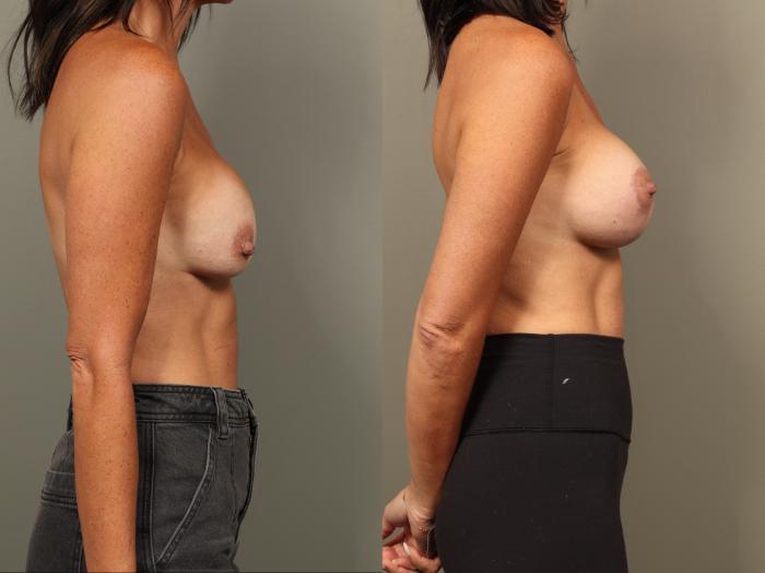 Before & After Breast Implant Exchange with Breast Lift  Case 501 Left Side View in Gilbert, AZ