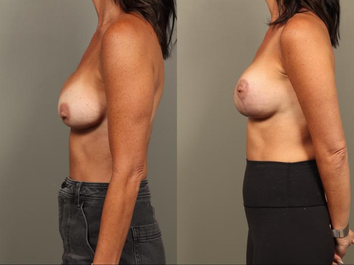 Before & After Breast Implant Exchange with Breast Lift  Case 501 Right Side View in Gilbert, AZ