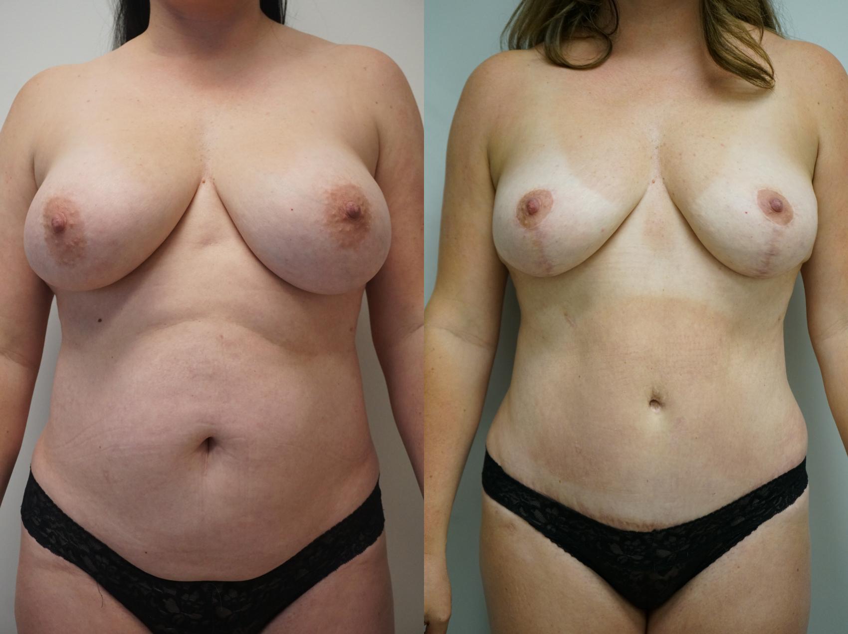 Before & After Tummy Tuck (Abdominoplasty) Case 329 Front View in Gilbert, AZ