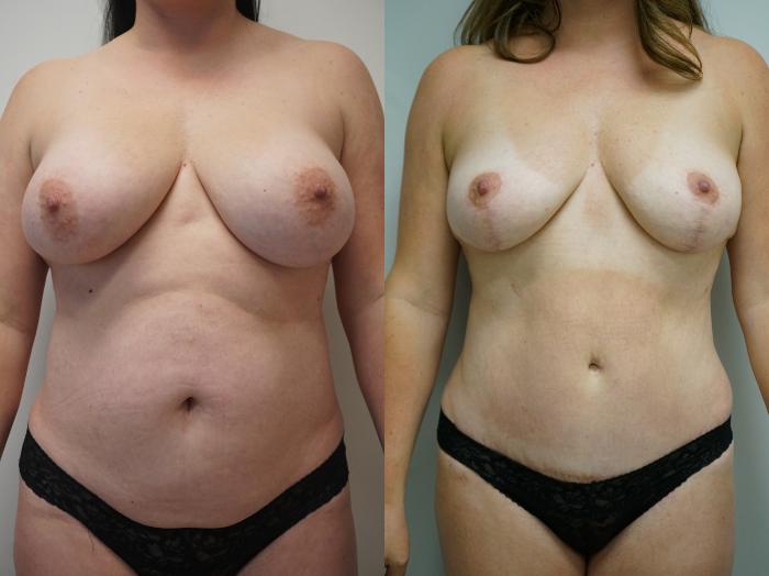 Before & After Breast Implant Removal Case 329 Front View in Gilbert, AZ