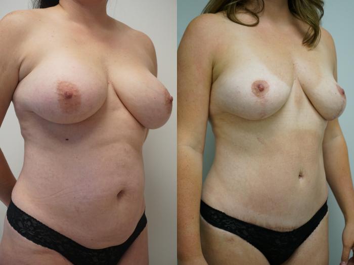 Before & After Tummy Tuck (Abdominoplasty) Case 329 Right Oblique View in Gilbert, AZ