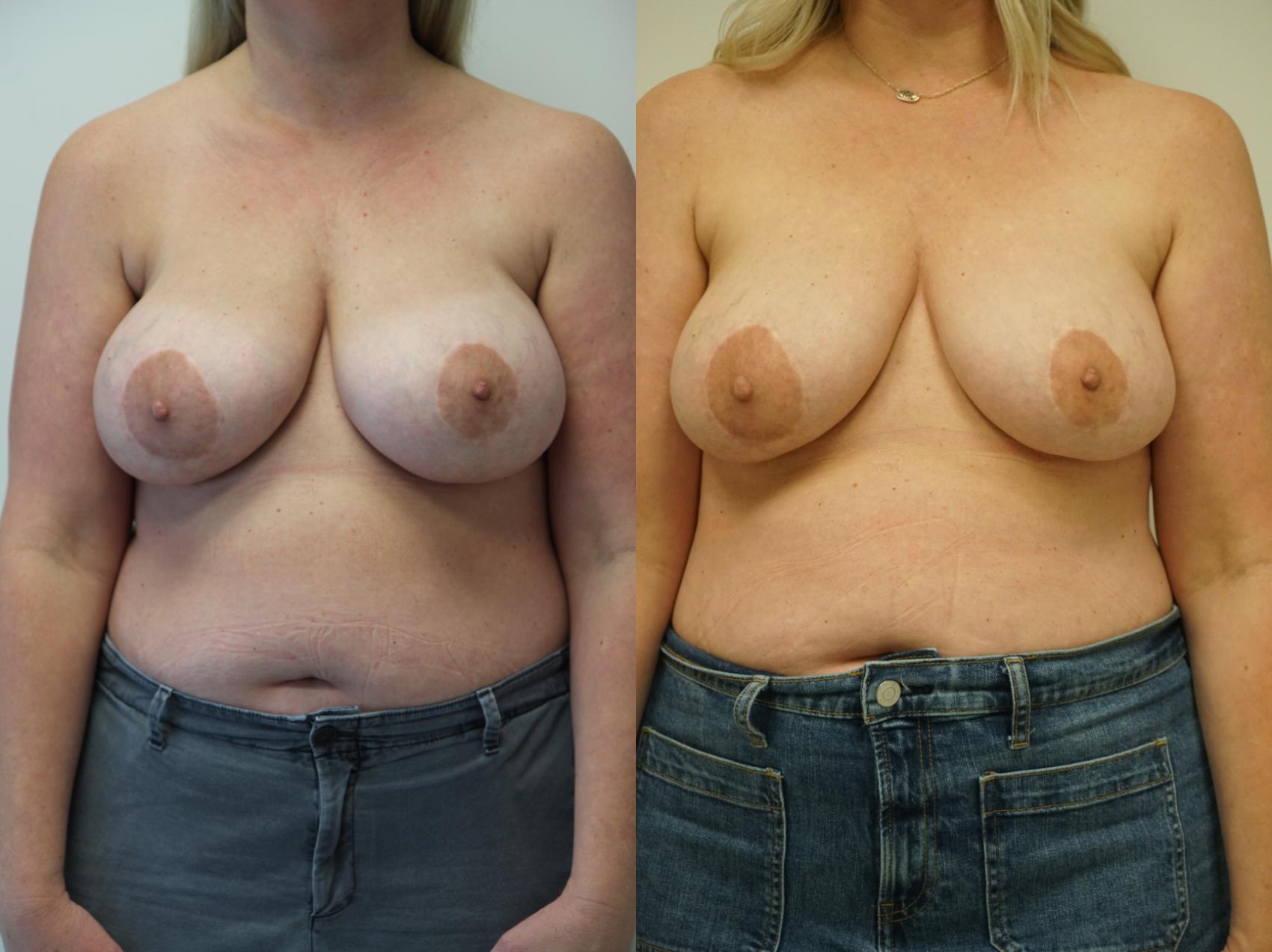 Before & After Breast Implant Removal Case 330 Front View in Gilbert, AZ