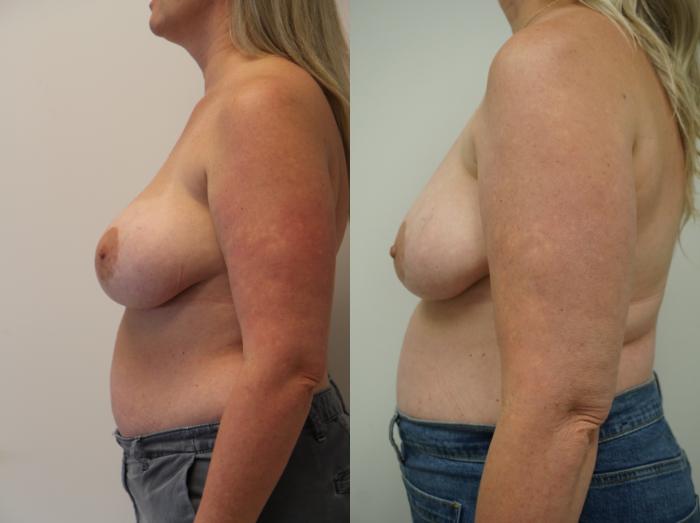 Before & After Breast Implant Removal Case 330 Right Oblique View in Gilbert, AZ