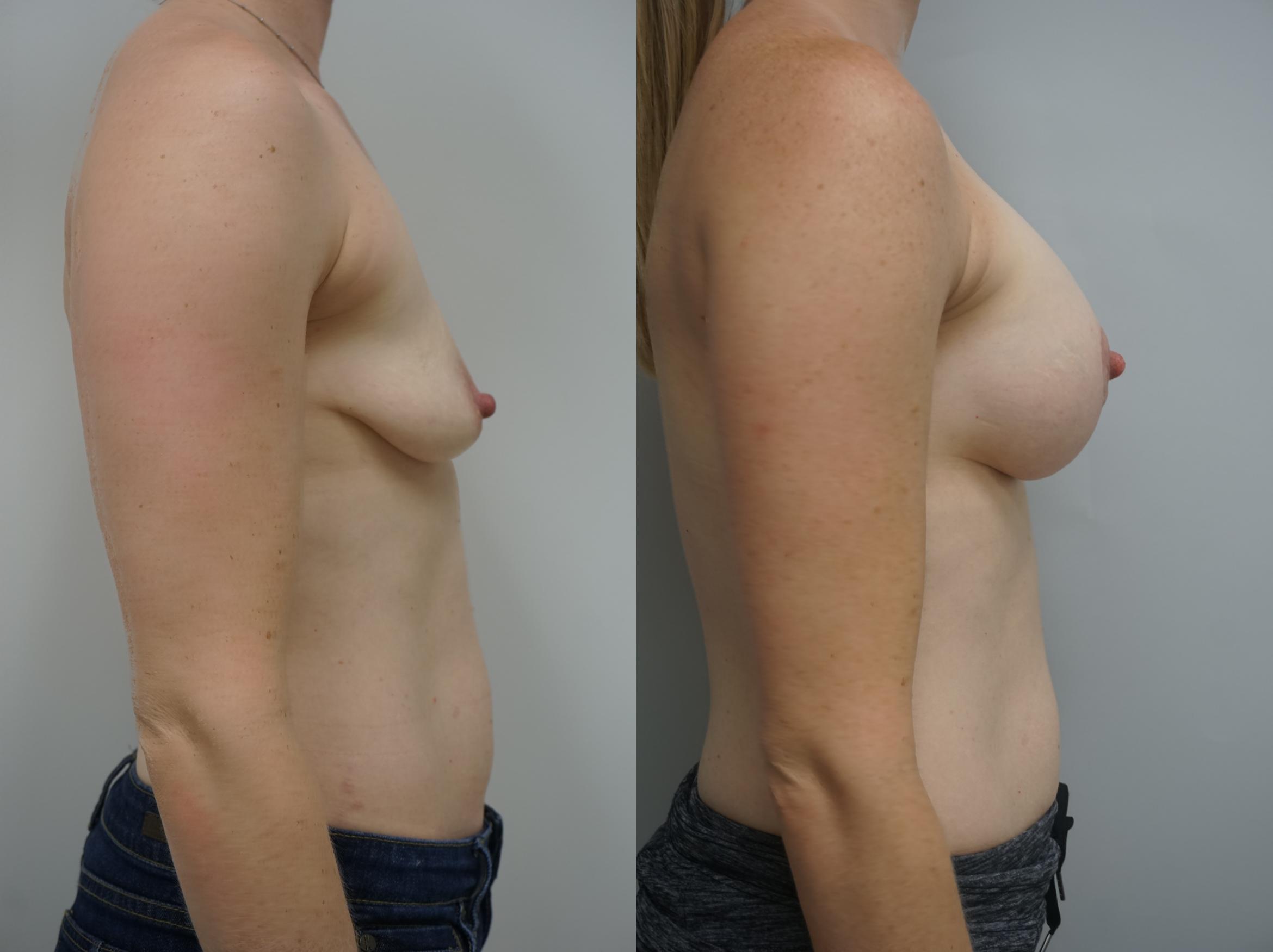 Before & After Breast Lift Case 172 View #1 View in Gilbert, AZ