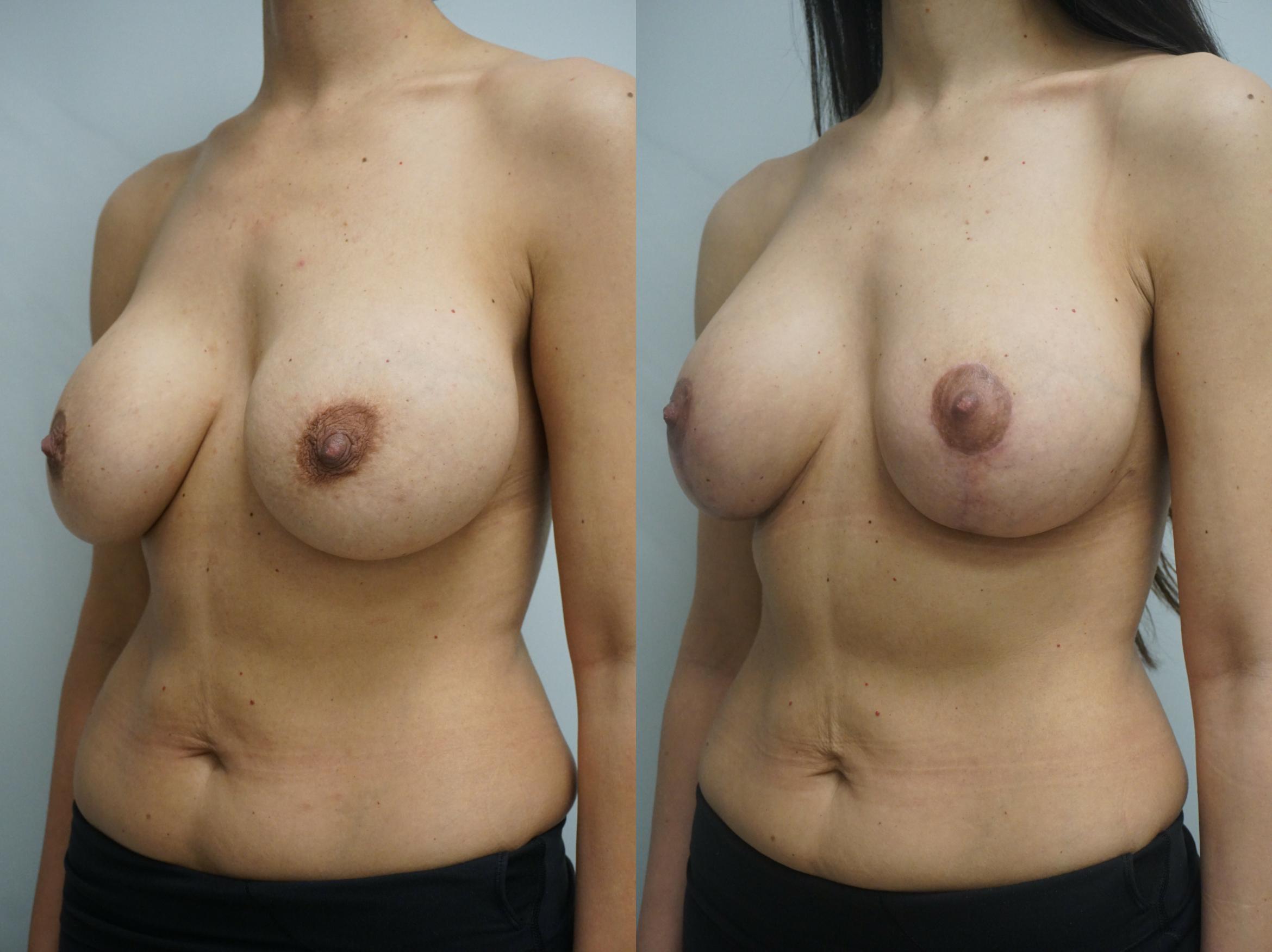 Before & After Breast Lift Case 245 View #1 View in Gilbert, AZ