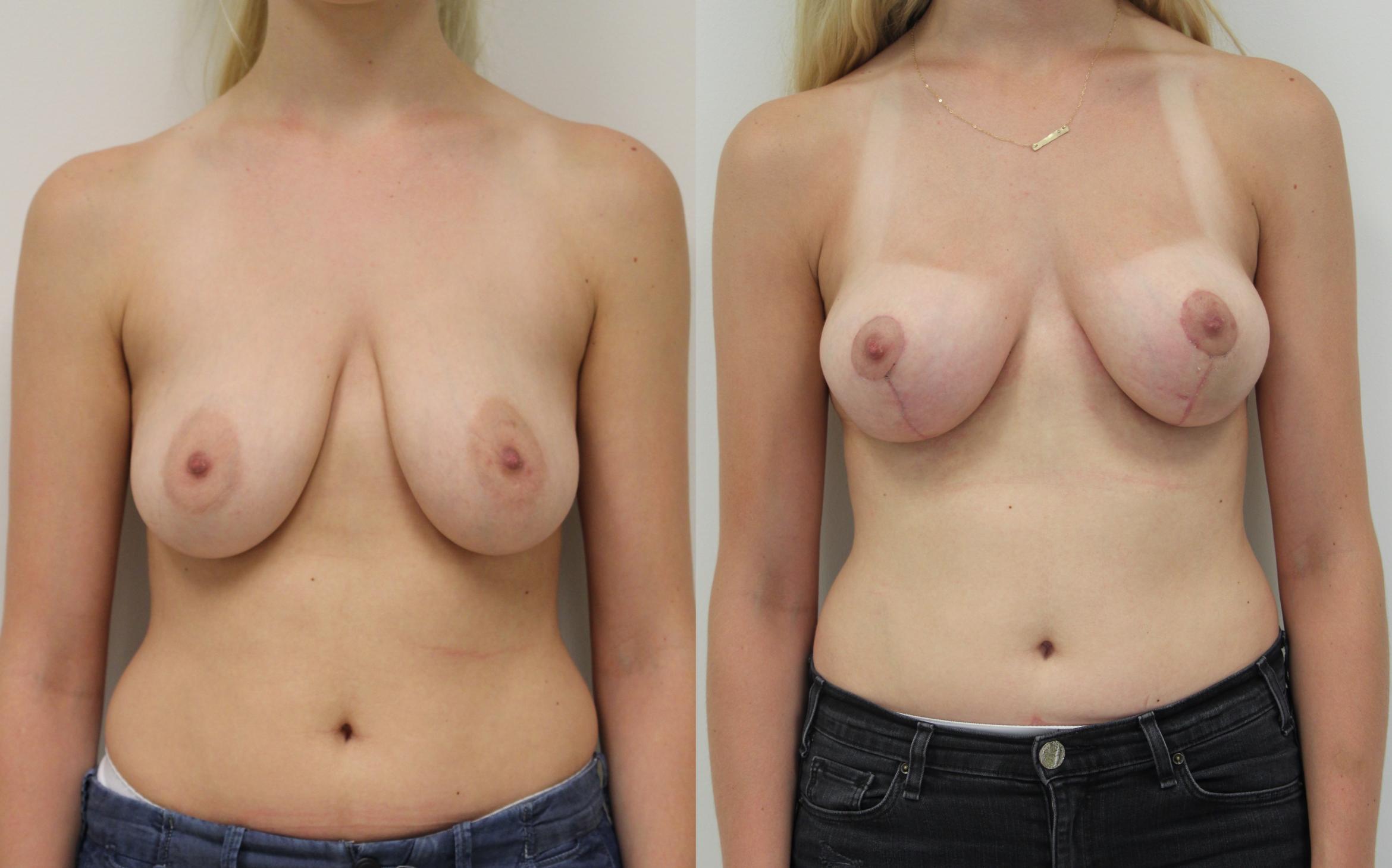 Before & After Breast Lift Case 33 View #1 View in Gilbert, AZ